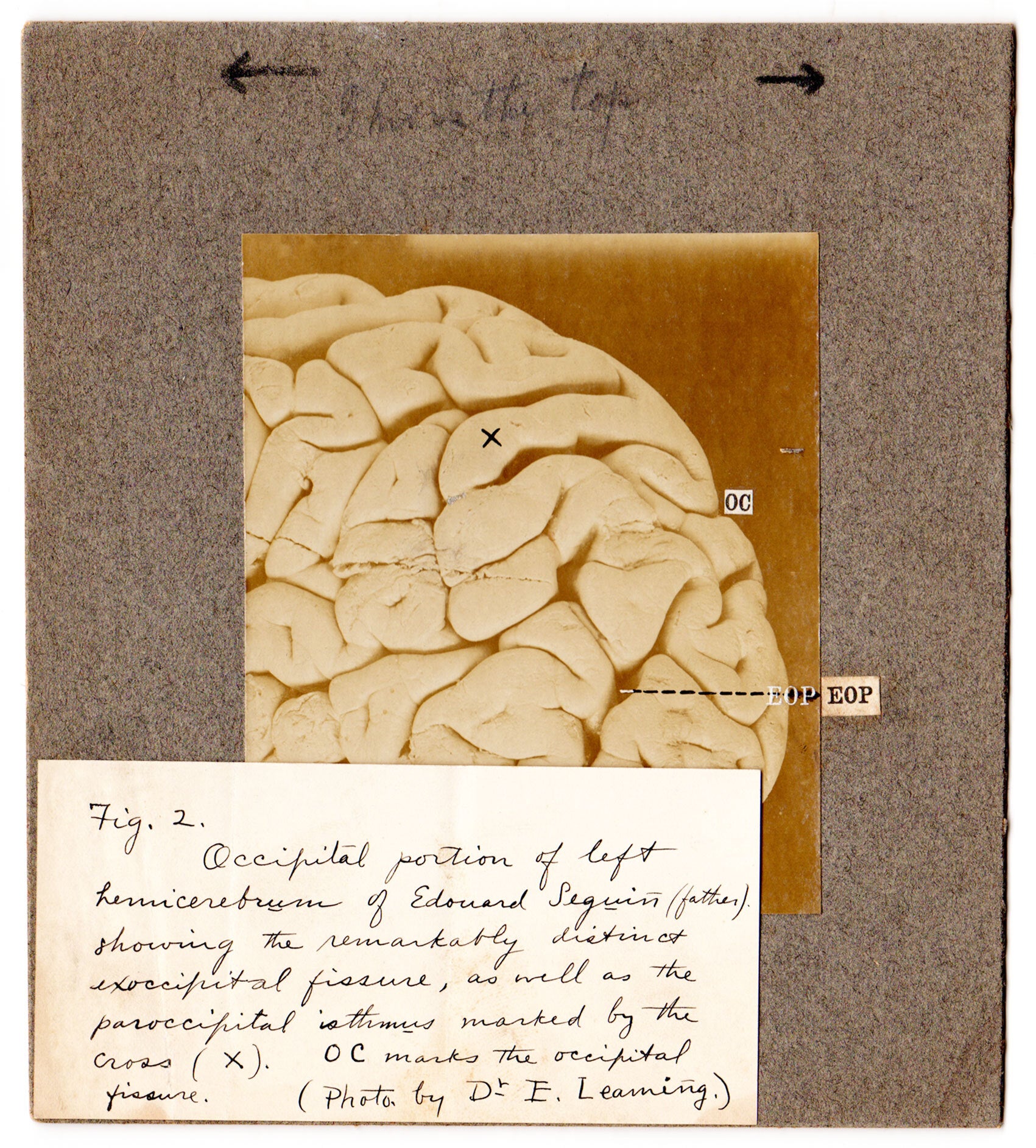 Medical Photos and Annotated Drawings by a Leading Brain Anatomist